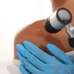 Close-up of a clinician wearing a blue medical glove examining a mole on a person's shoulder using a handheld dermatoscope.